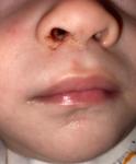 Кровяные корочки в носу ребенка фото 1