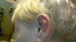 Паракератоз ушных раковин фото 1
