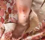 Красное нарастание с уплотнением кожи на ноге фото 2