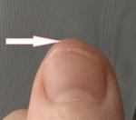 Шишка, (твердое образование) по кожей на кончике большого пальца руки фото 2