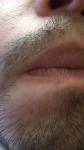 Сухость кожи, шелушение и странные катушки в волосистой части усов фото 4