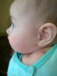 Мелкая сыпь на щеках у ребенка фото 1