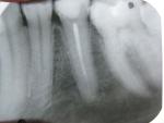 Чувствительность зуба с удалённым нервом фото 1