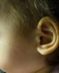 Красные пятна и сыпь у ребенка 2 года на лице фото 1