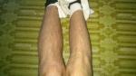 Ноги в узлах, болят, судороги, не можем понять диагноз фото 3