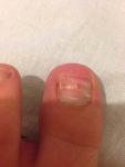Последствия операции по удалению вросшего ногтя фото 2