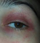 Аллергия на подбородке и глазах фото 2
