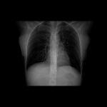 Фиброз и астма фото 2