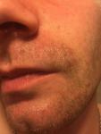 Пятна на лице вокруг: рта, носа, бровей и на лбу фото 2