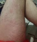 Высыпания на коже, аллергия фото 2
