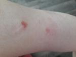 Красные пятна на руке, чешутся, не аллергия, возможно дерматит фото 2