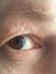 Заболевание глаза пузырек фото 1