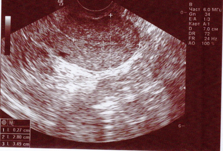 После удаления матки могут ли быть выделения. Фото миома и беременность.