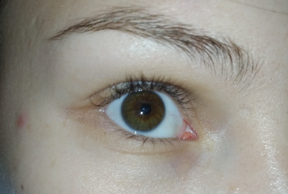 Eye corner. Воспаление в уголке глаза. Воспаление слезного мясца. Белое воспаление в уголке глаза.