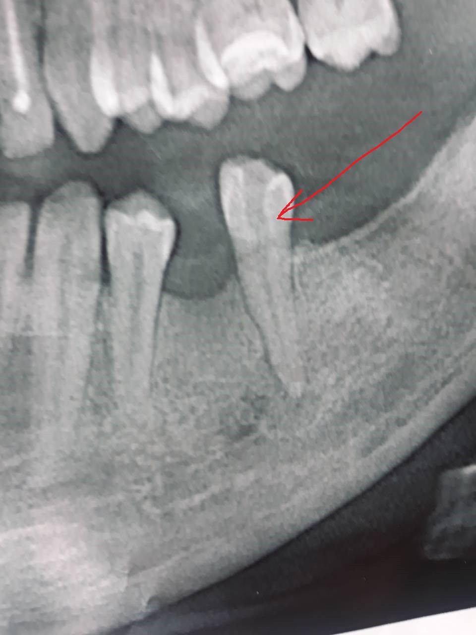 Удаление зуба семерки. Корневая (радикулярная) киста. Киста корня зуба рентген.