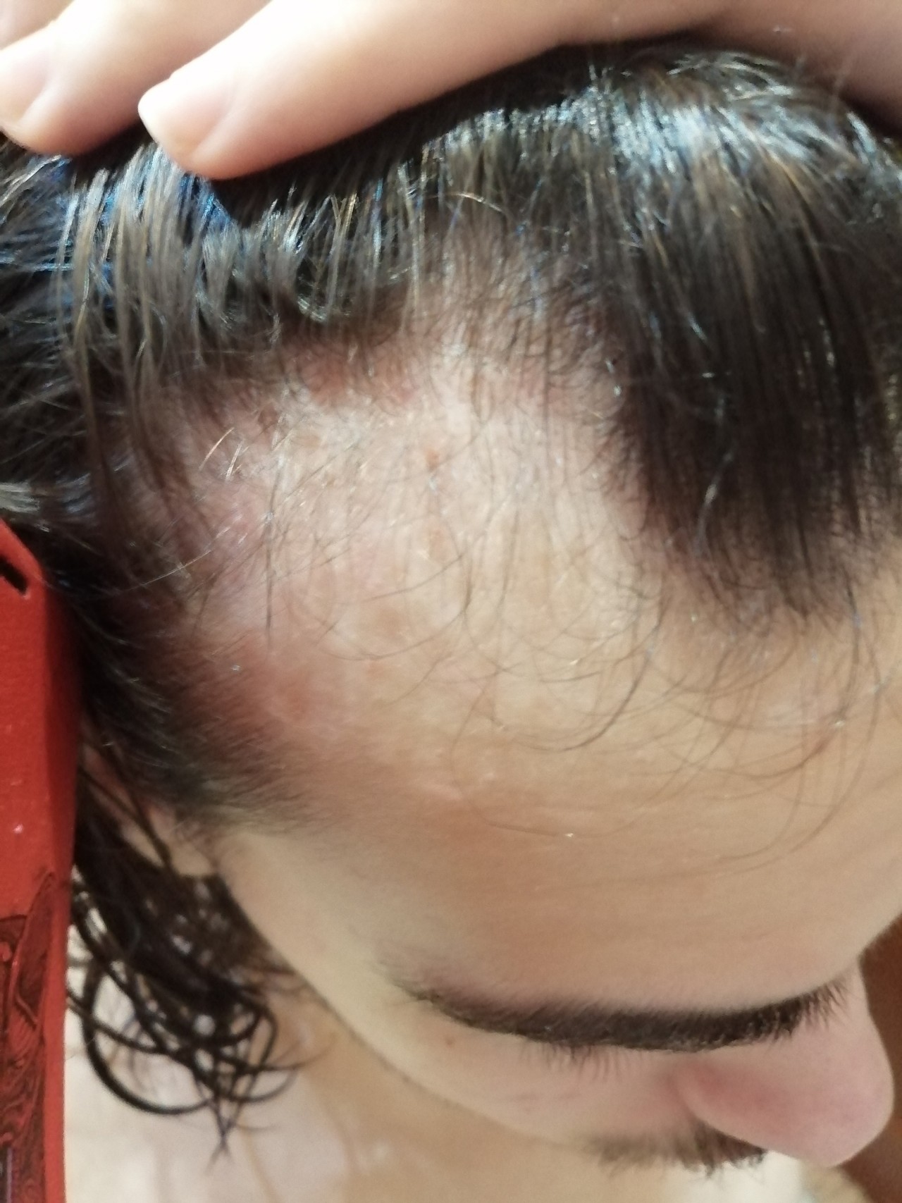 Выпадают ли волосы от элоксатин