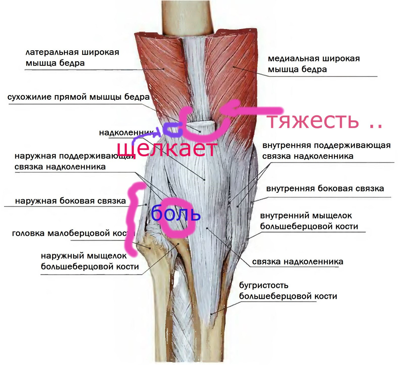 Подколенная связка растяжение