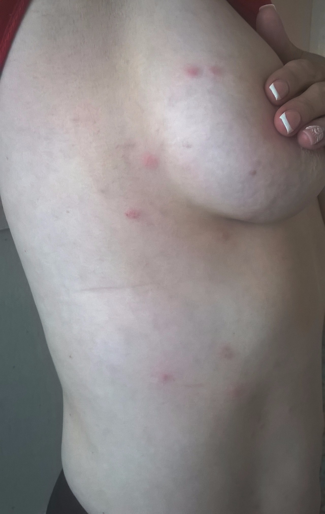 красные высыпания на груди у женщин фото 12