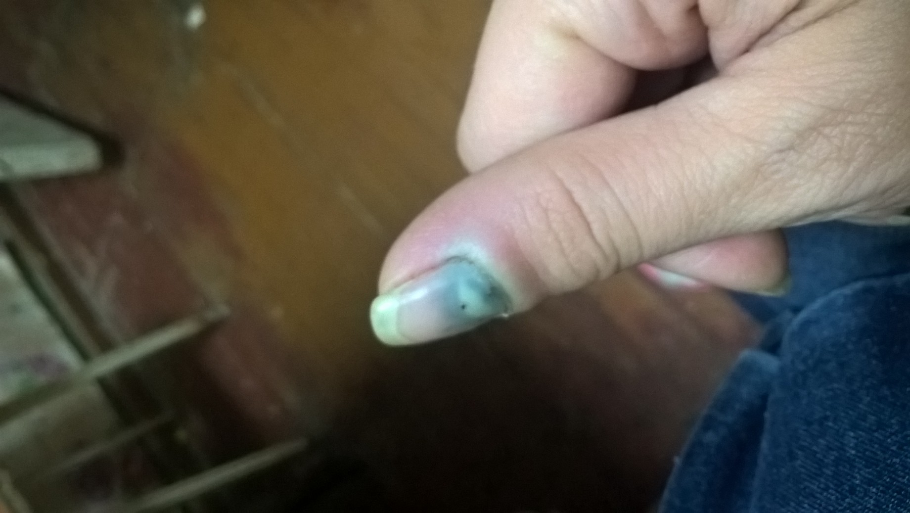 Ушиб ногтя большого пальца